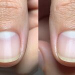 rak paznokcia po hybrydzie objawy i diagnostyka